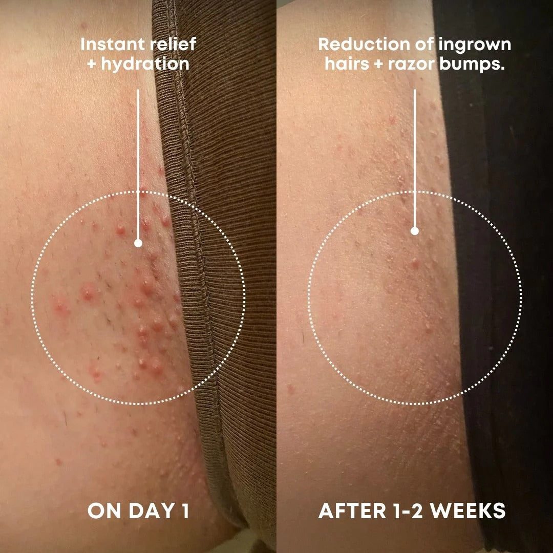 Sweet Escape Ingrown Hair Oil