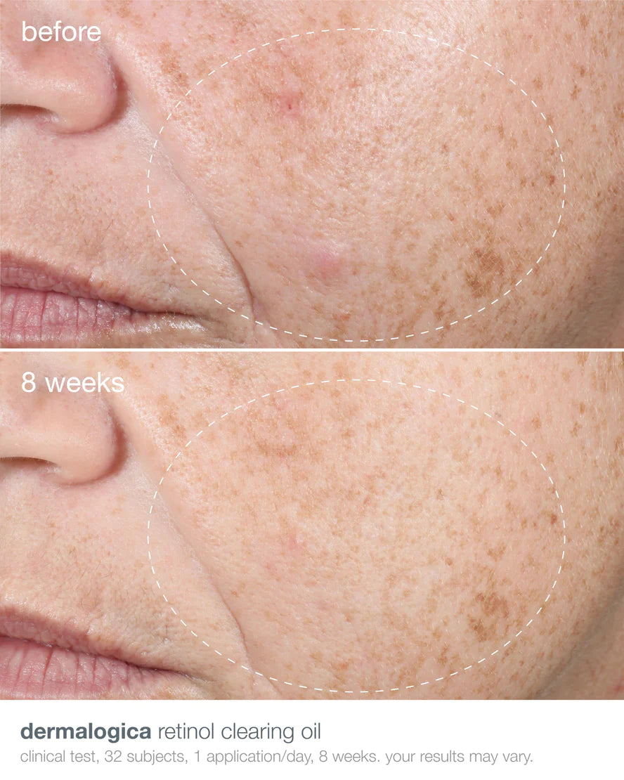 Retinoid Clearing Oil